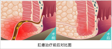 福州肛肠医院