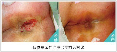 福州肛肠医院 福州医博肛肠医院 福州看痔疮的医院 福州肛瘘医院 福州肛裂医院 福州肠炎医院