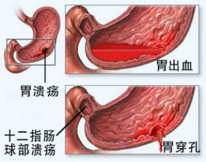 得了胃溃疡如何治疗 什么原因引起胃溃疡