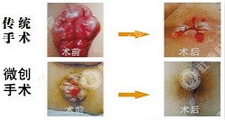 痔疮不止长在外面，治疗内痔更重要！福州痔疮医院