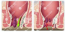 痔疮不止长在外面，治疗内痔更重要！福州痔疮医院