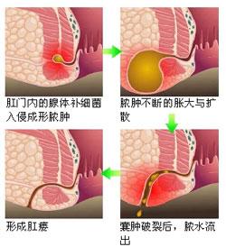 福州治肛瘘哪个医院好