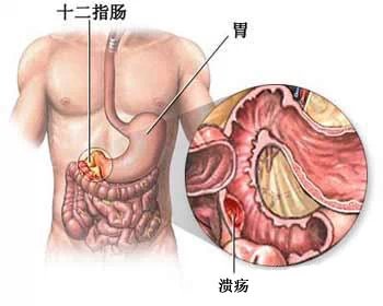 福州治胃溃疡哪个医院好