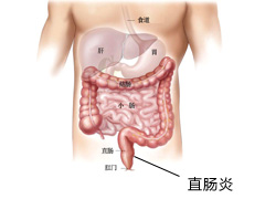 福州肛肠医院 福州医博肛肠医院 福州看痔疮的医院 福州肛瘘医院 福州肛裂医院 福州肠炎医院