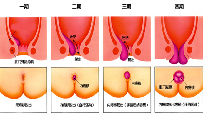 福州痔疮怎么治疗