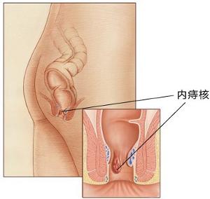 福州痔疮怎么治疗