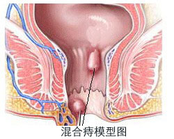 福州痔疮不治会好吗