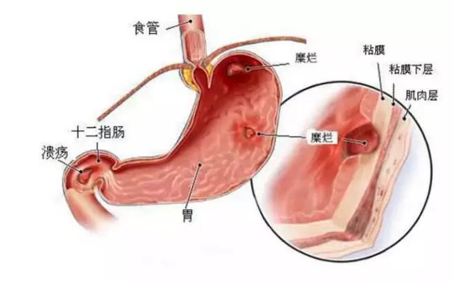 真实案例分享| 感染了幽门螺杆菌，怎么办？