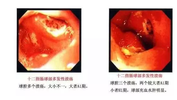 真实案例分享| 感染了幽门螺杆菌，怎么办？