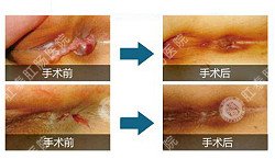 福州肛肠医院 福州医博肛肠医院 福州看痔疮的医院 福州肛瘘医院 福州肛裂医院 福州肠炎医院