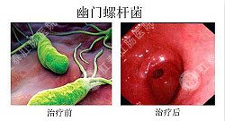 福州肛肠医院 福州医博肛肠医院 福州看痔疮的医院 福州肛瘘医院 福州肛裂医院 福州肠炎医院