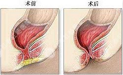 福州肛肠医院 福州医博肛肠医院 福州看痔疮的医院 福州肛瘘医院 福州肛裂医院 福州肠炎医院