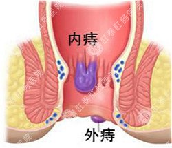 福州肛肠医院 福州医博肛肠医院 福州看痔疮的医院 福州肛瘘医院 福州肛裂医院 福州肠炎医院