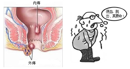 痔疮病人自我调理理疗和饮食法