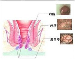 福州肛肠医院 福州医博肛肠医院 福州看痔疮的医院 福州肛瘘医院 福州肛裂医院 福州肠炎医院