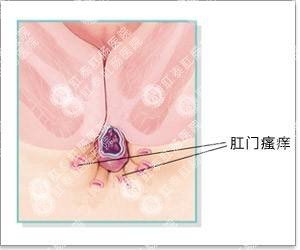 福州肛肠医院 福州医博肛肠医院 福州看痔疮的医院 福州肛瘘医院 福州肛裂医院 福州肠炎医院