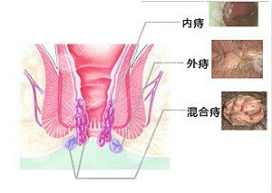 福州肛肠医院 福州医博肛肠医院 福州看痔疮的医院 福州肛瘘医院 福州肛裂医院 福州肠炎医院