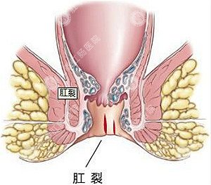 福州肛肠医院 福州医博肛肠医院 福州看痔疮的医院 福州肛瘘医院 福州肛裂医院 福州肠炎医院