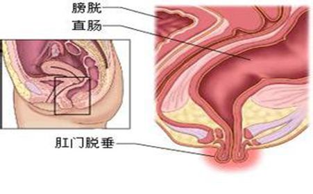 脱肛的症状是怎么引起的？哪些疾病会导致脱肛