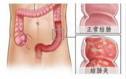 福州肛肠医院 福州医博肛肠医院 福州看痔疮的医院 福州肛瘘医院 福州肛裂医院 福州肠炎医院