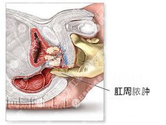 福州肛周脓肿那家医院好，