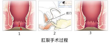 福州肛裂治疗医院排名那家好？