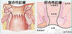 福州肛肠医院 福州医博肛肠医院 福州看痔疮的医院 福州肛瘘医院 福州肛裂医院 福州肠炎医院