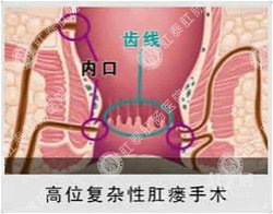 福州肛肠医院 福州医博肛肠医院 福州看痔疮的医院 福州肛瘘医院 福州肛裂医院 福州肠炎医院