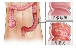 福州肛肠医院 福州医博肛肠医院 福州看痔疮的医院 福州肛瘘医院 福州肛裂医院 福州肠炎医院