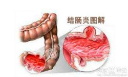 福州肛肠医院 福州医博肛肠医院 福州看痔疮的医院 福州肛瘘医院 福州肛裂医院 福州肠炎医院