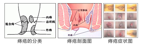 福州肛肠医院 福州医博肛肠医院 福州看痔疮的医院 福州肛瘘医院 福州肛裂医院 福州肠炎医院