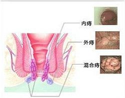 痔疮分类和危害,治疗很重要