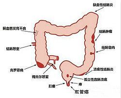 肠道疾病常识三大项，你都了解了吗？  福建医博肛肠 