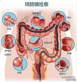 肠道疾病常识三大项，你都了解了吗？  福建医博肛肠 