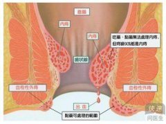 痔疮脱肛的危害是什么 痔疮脱肛四大危害不可忽