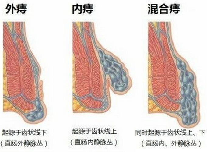 痔疮几个误区，千万别把它们当常识