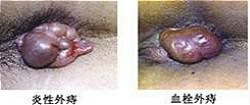 肛门口长了个小肉球状不痛不痒图片