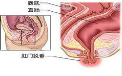 肛门脱落的症状是什么引起的