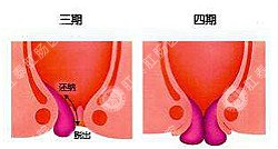 福州治疗痔疮的医院哪家好，选择创口微小办法