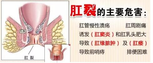 忍无可忍无须再忍，肛裂大作战势在必行！