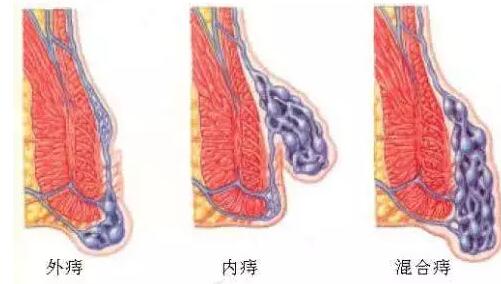 还对痔疮一知半解？知识问答帮您解惑！