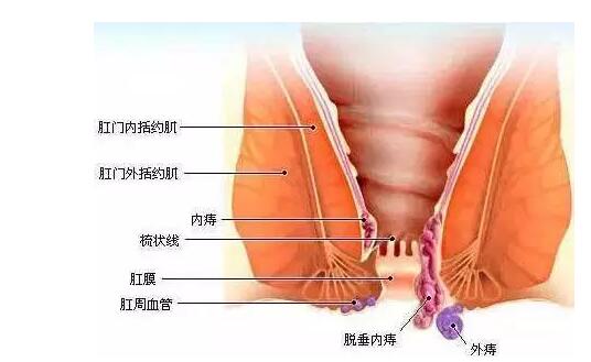 还对痔疮一知半解？知识问答帮您解惑！