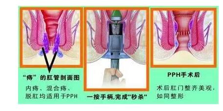 还对痔疮一知半解？知识问答帮您解惑！