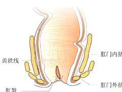 肛裂