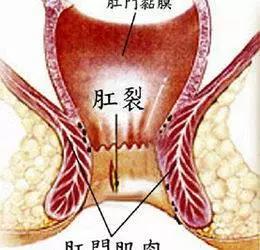 为什么肛裂久治不愈