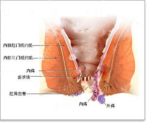 如何自我判断是否患有痔疮