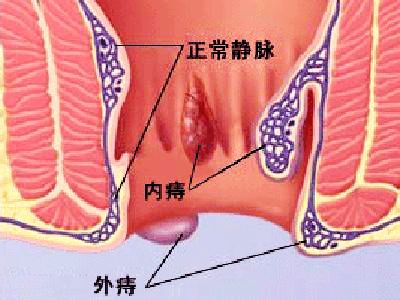 福州肛肠医院