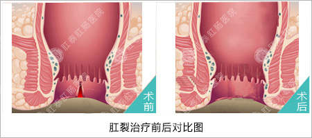 福州肛肠医院