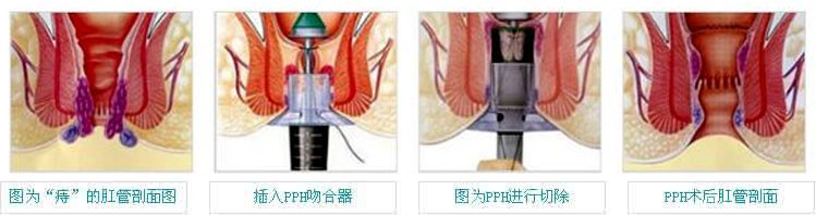 福州肛肠医院