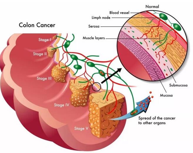 为什么肠癌一发现就是晚期？难道身体没有提前发出预警信号吗？